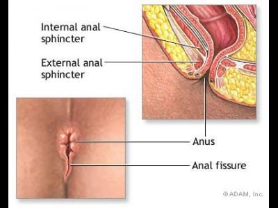 Fisura anala - tratamentul